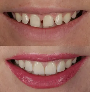 Реставрация зубов в стоматологической клинике